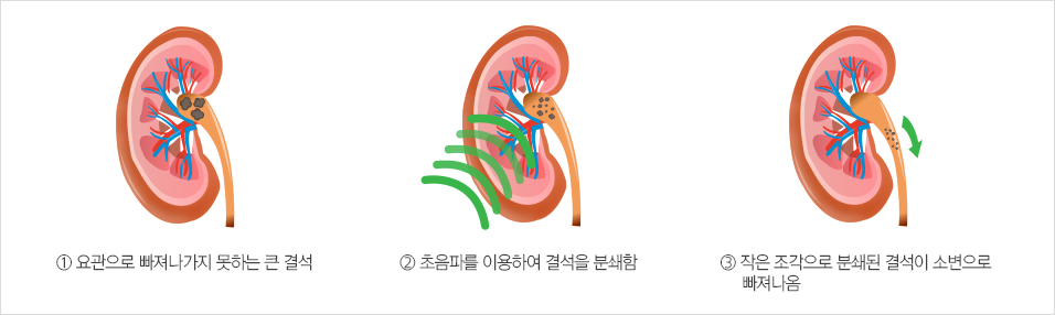 체외충격파쇄석술 치료과정